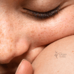La Neurofibromatosi di tipo 1 è tra le malattie rare, una delle più frequenti. Si tratta di una malattia associata a una mutazione della neurofibromina, una proteina codificata dal gene oncosoppressore NF1, che predispone allo sviluppo di tumori con una probabilità maggiore del normale. Coinvolge diversi distretti corporei come la cute, gli occhi, il sistema nervoso centrale e le ossa. La malattia colpisce nel mondo una persona su 3 mila e in Italia si stima coinvolga circa 20 mila pazienti, che raccontano una condizione molto eterogenea con casi lievi e casi molto gravi.