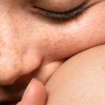 La Neurofibromatosi di tipo 1 è tra le malattie rare, una delle più frequenti. Si tratta di una malattia associata a una mutazione della neurofibromina, una proteina codificata dal gene oncosoppressore NF1, che predispone allo sviluppo di tumori con una probabilità maggiore del normale. Coinvolge diversi distretti corporei come la cute, gli occhi, il sistema nervoso centrale e le ossa. La malattia colpisce nel mondo una persona su 3 mila e in Italia si stima coinvolga circa 20 mila pazienti, che raccontano una condizione molto eterogenea con casi lievi e casi molto gravi.